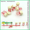 VERKAUFEN 12577 Stained Wurzelkanal Endodontie Tooth Modell 8pcs / set Endo Zähne